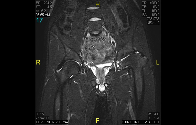 Figure 4 for case History Perthes Disease